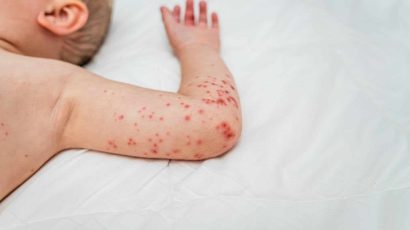 Measles case could mean wider transmission possible, as contact events listed